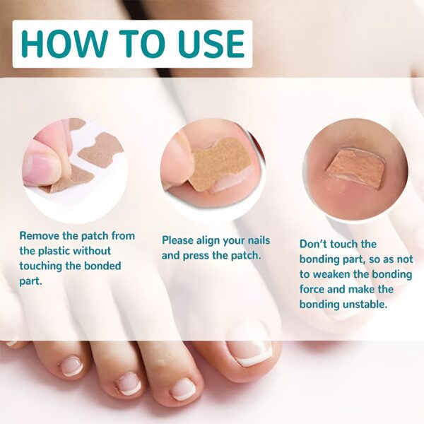30 pcs - glue free ingrow toenail corrector stickers | ingrown toe nail pain reliever patches - Image 8