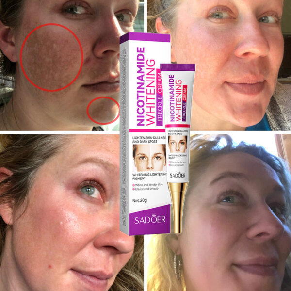 nicotinamide whitening freckles cream remove melasma dark spot acne marks lightening melanin brightens skin tone face skin care - Image 13