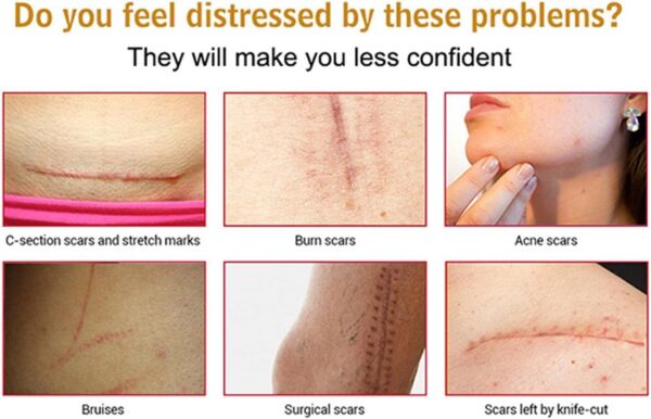 acne scar removal rejuvenation serum | scar, c section & stretch mark removal oil for women - Image 6