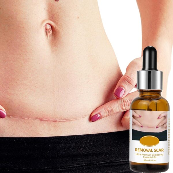 acne scar removal rejuvenation serum | scar, c section & stretch mark removal oil for women - Image 2