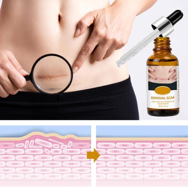 acne scar removal rejuvenation serum | scar, c section & stretch mark removal oil for women - Image 3