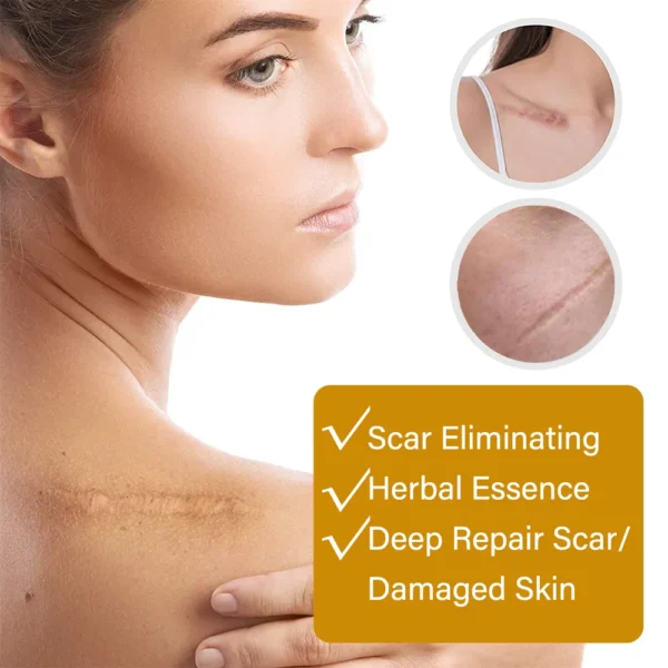 acne scar removal rejuvenation serum | scar, c section & stretch mark removal oil for women - Image 10