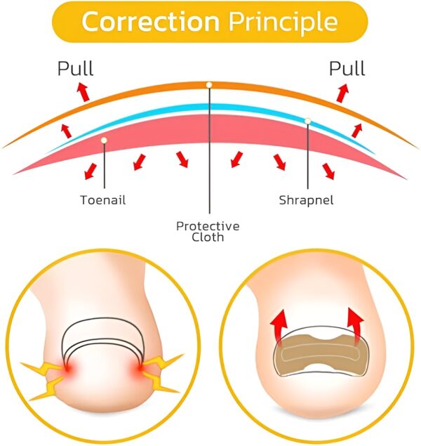 30 pcs - glue free ingrow toenail corrector stickers | ingrown toe nail pain reliever patches - Image 11