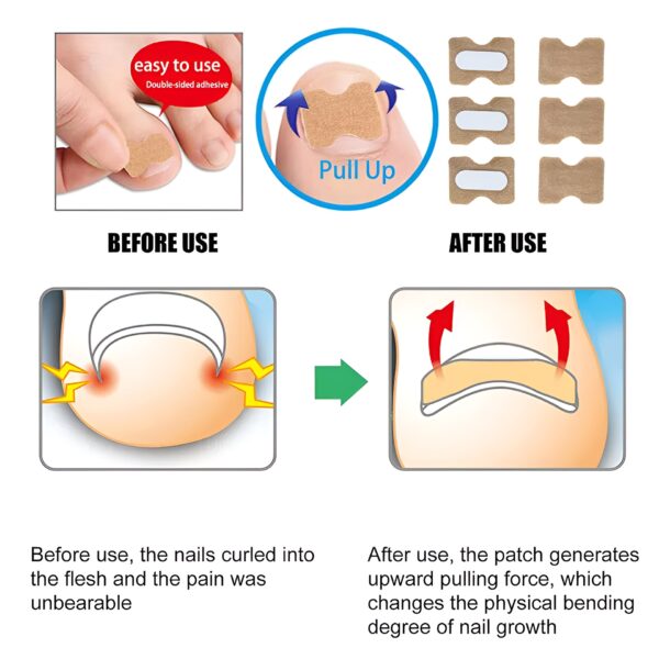 30 pcs - glue free ingrow toenail corrector stickers | ingrown toe nail pain reliever patches - Image 5