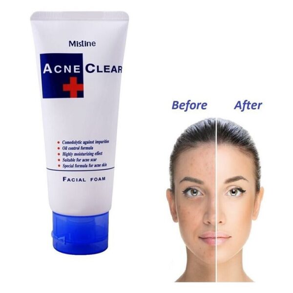 acne clear facial foam wash, 85ml