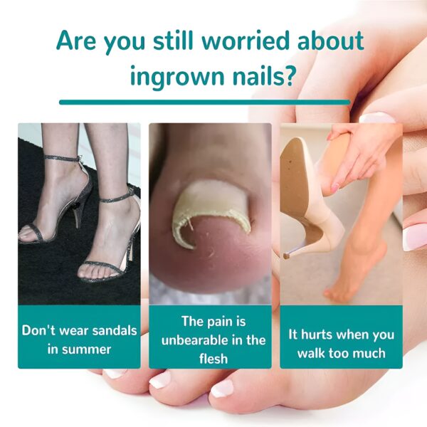 30 pcs - glue free ingrow toenail corrector stickers | ingrown toe nail pain reliever patches - Image 6