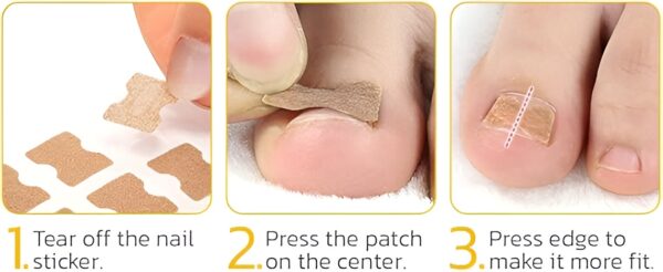 30 pcs - glue free ingrow toenail corrector stickers | ingrown toe nail pain reliever patches - Image 12