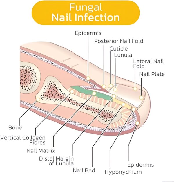 30 pcs - glue free ingrow toenail corrector stickers | ingrown toe nail pain reliever patches - Image 10